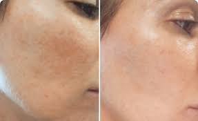 Mask & Glo 7 0 - Before and After Results
