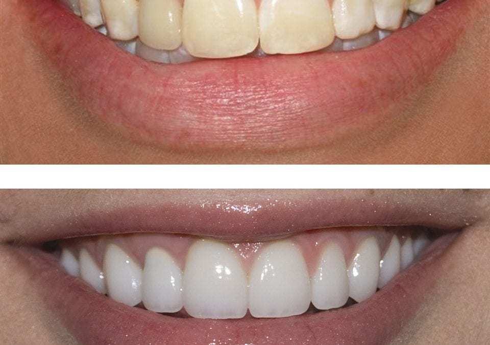 OnlySmiles Ultrasonic Tooth Cleaner - Before and After Result