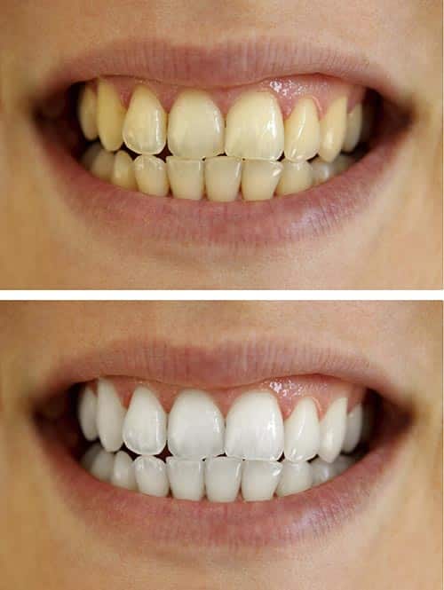PurelyWhite Deluxe Teeth Whitening Kit - Before and After Results