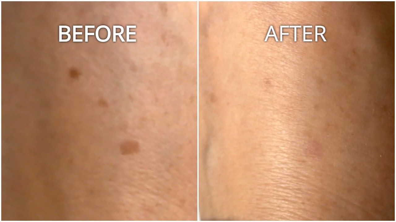 Alphaluxy Plasma Pen - Before and After Results