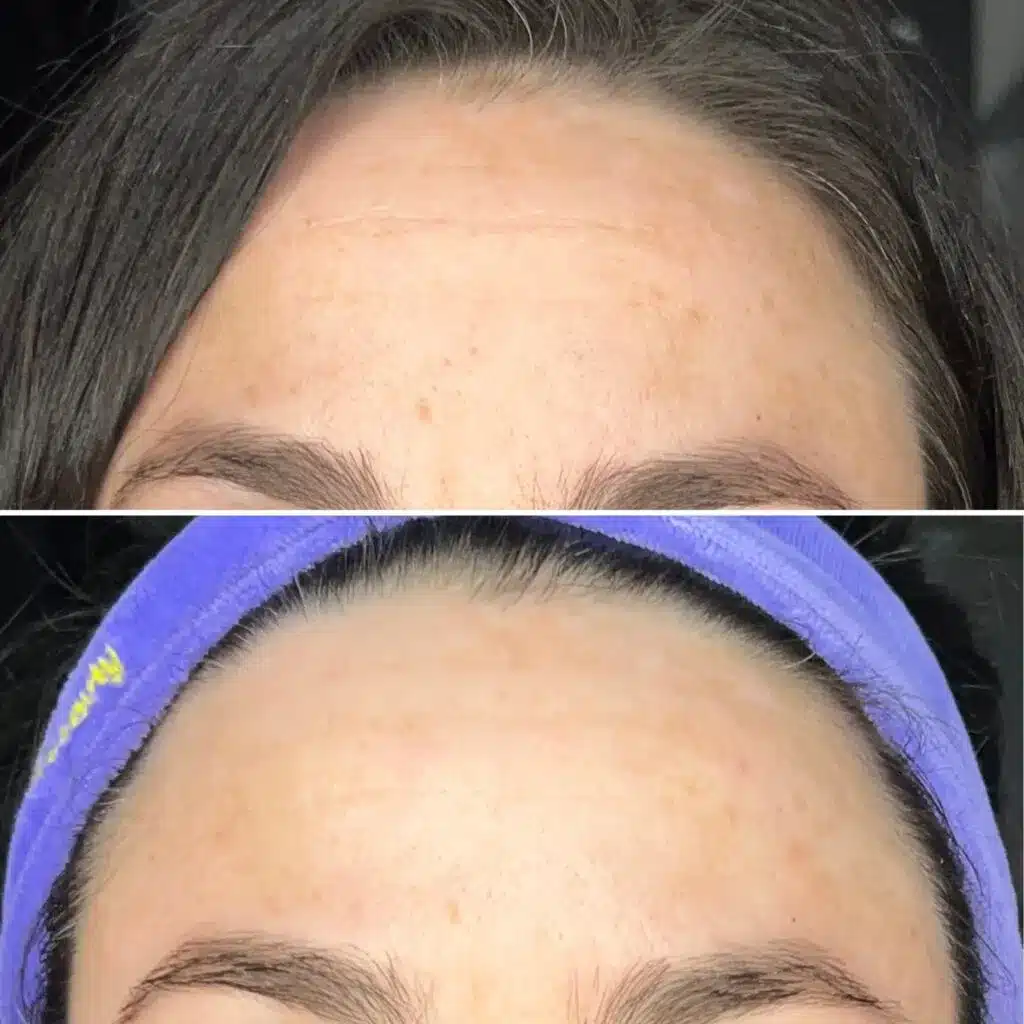CurrentBody Skin LED Mask - Before and After Results