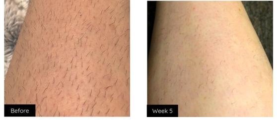 Glow Skin Co Laser Hair Removal – Before and After Result