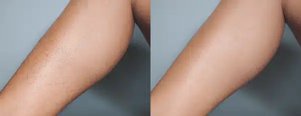 Lux Skin Laser Hair Removal - Before and After Results