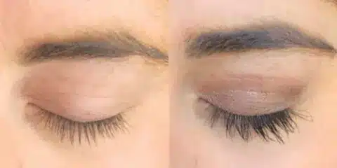 Nulastin - Before and After Results
