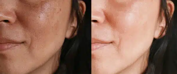 Ocuralife Plasma Pen - Before and After Results