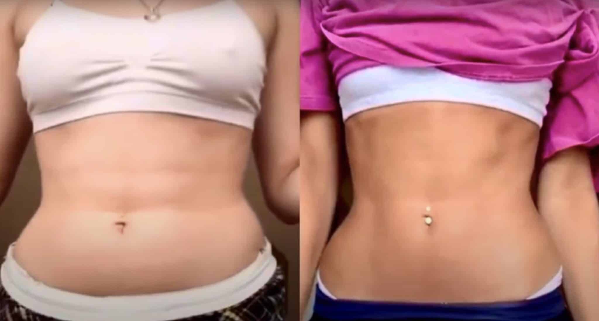 UltraCavitat Fat & Cellulite Remover - Before and After Results