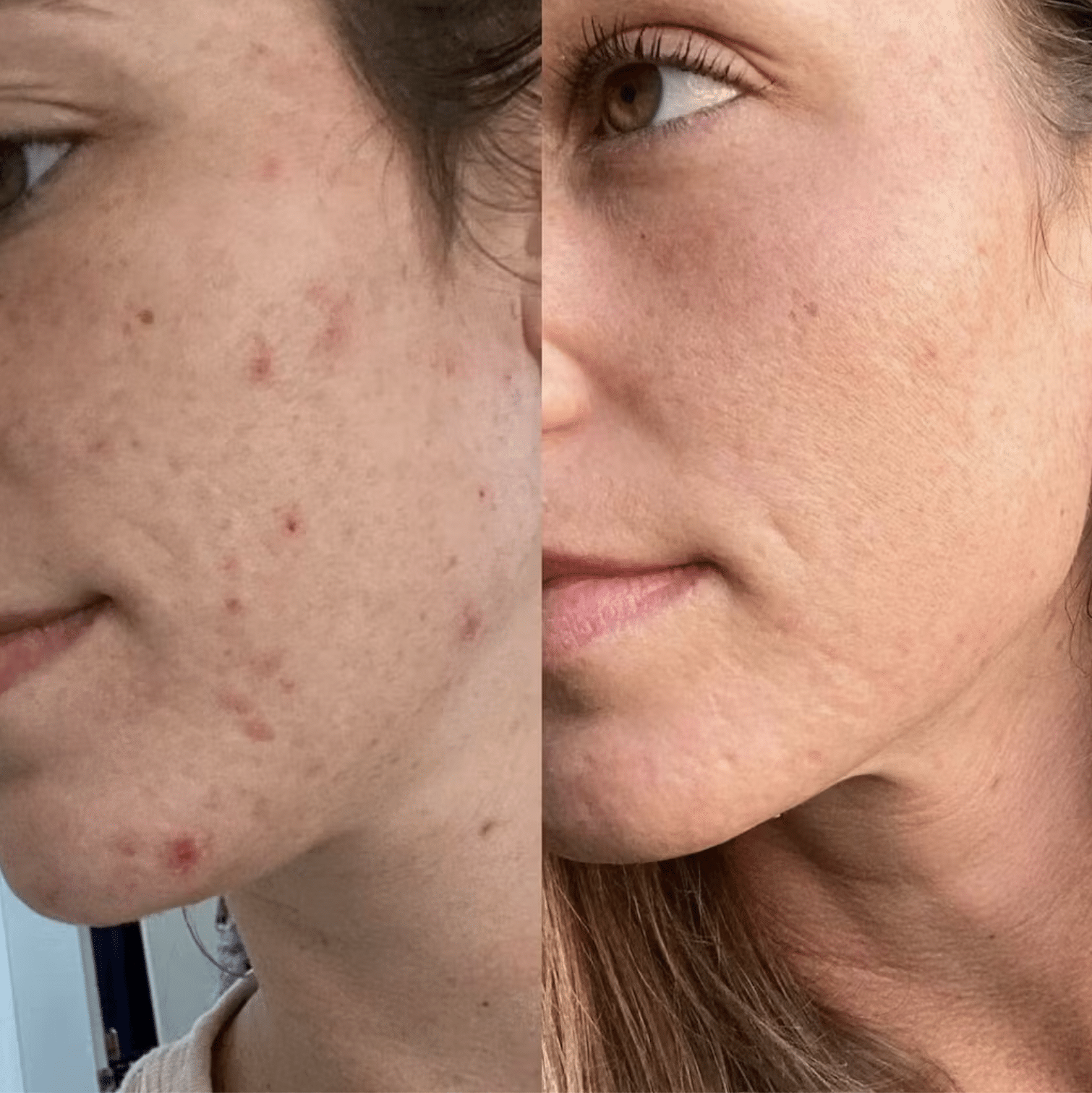 BioLux Light Therapy Mask - Before and After Results