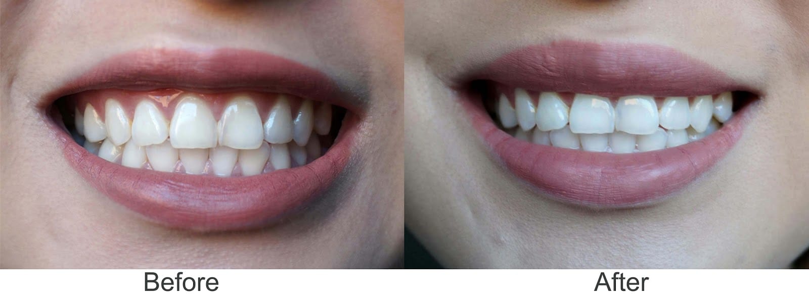 Sani White Toothbrush - Before and After Results