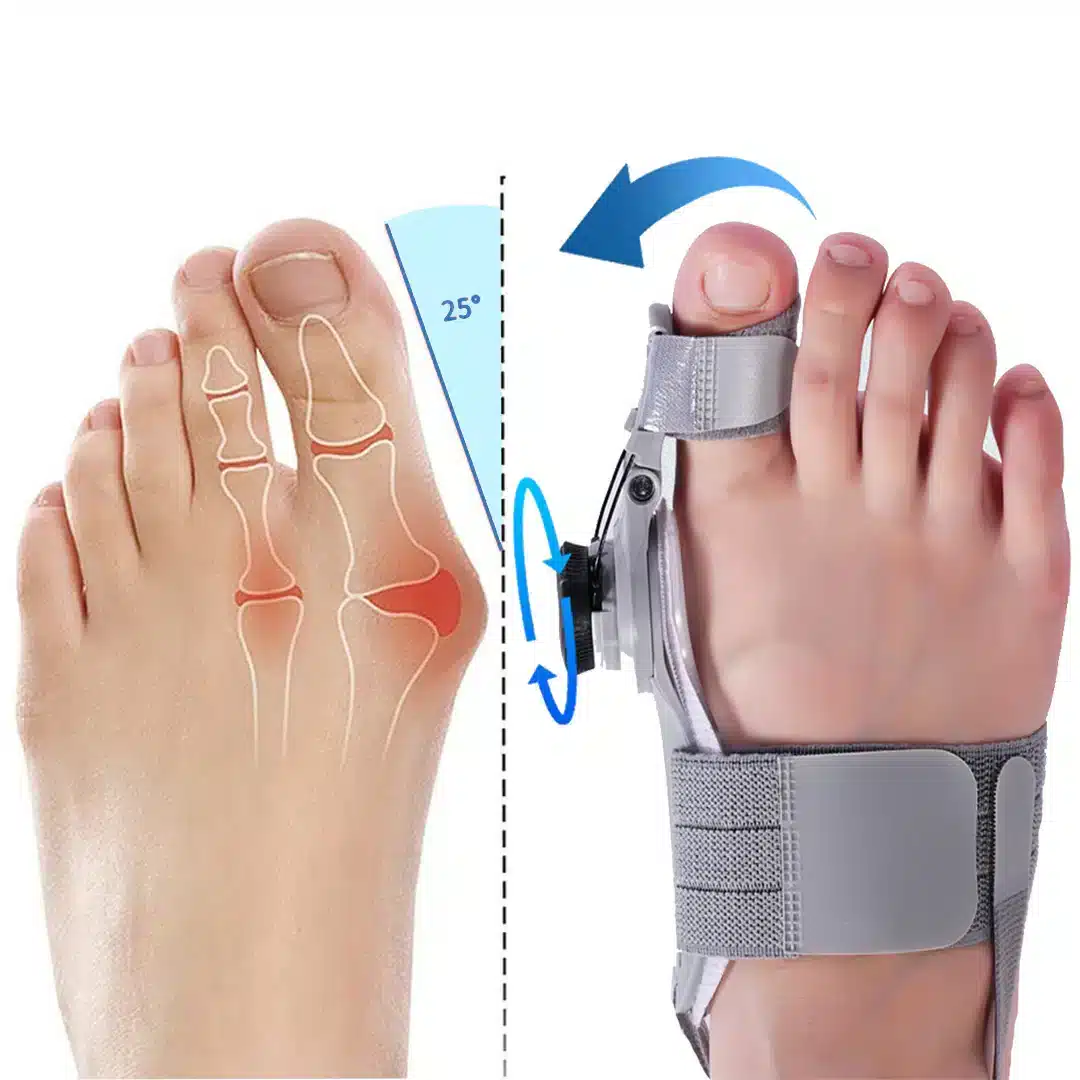 Treatmedy Bunion Fix Reviews